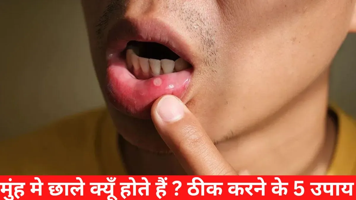 Home Remedies Of Mouth Ulcers मुंह मे छाले क्यूँ होते हैं ठीक करने के 5 उपाय