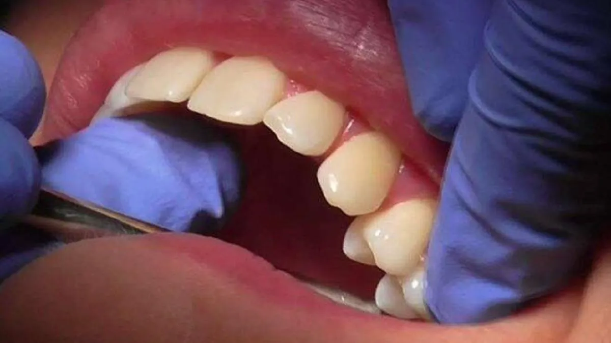दांत में दर्द क्यों होता है? | दांत दर्द का अचूक इलाज